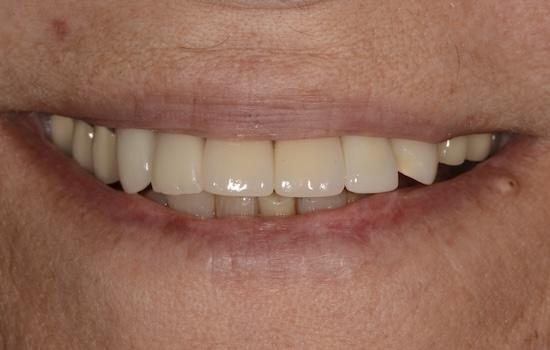Case 7 after