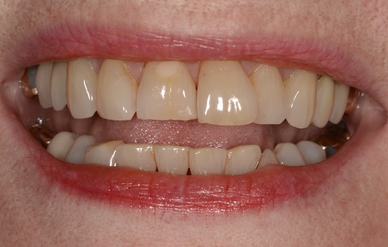 Case 8 after
