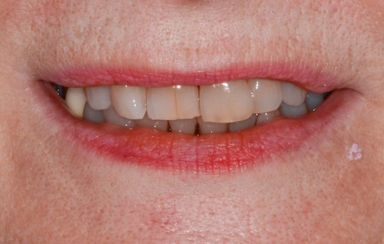Case 8 before
