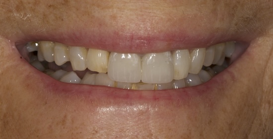 Case 6 after