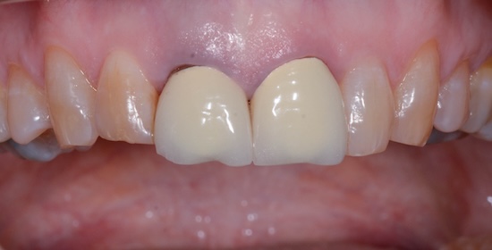 Case 6 before