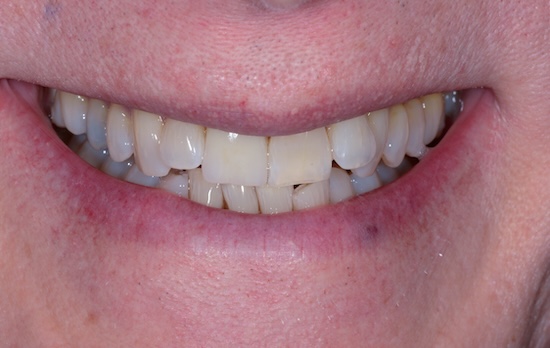 Case 1 after