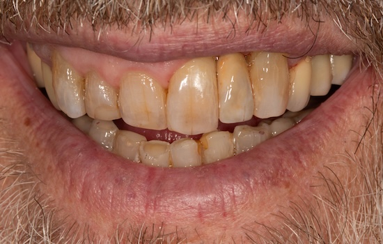Case 4 after