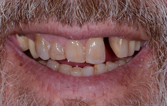 Case 4 before
