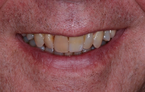 Case 5 after