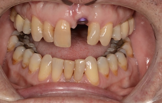 Case 5 before