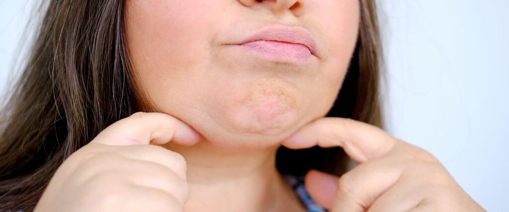 Middle aged woman's baggy chin ptosis.