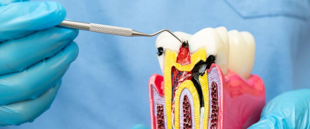 Dentist holding root canal education model