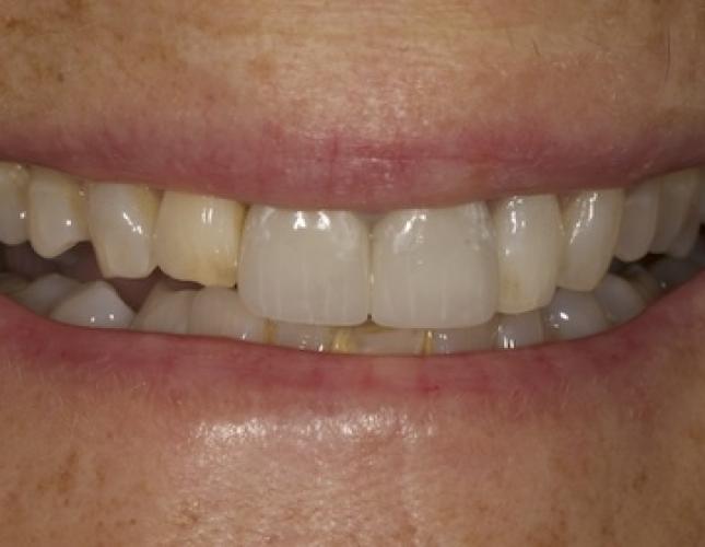 Case 6 after