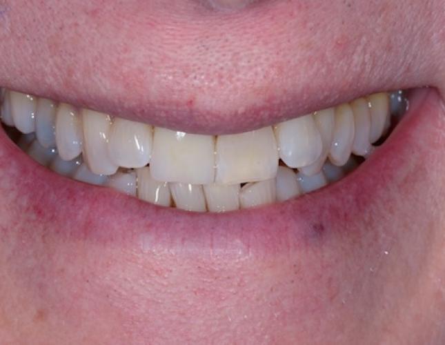 Case 1 after