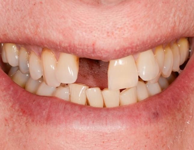 Case 1 before