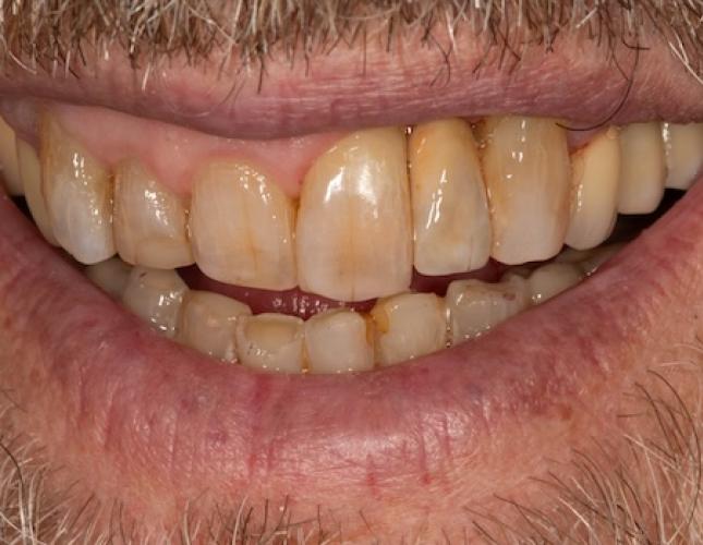 Case 4 after