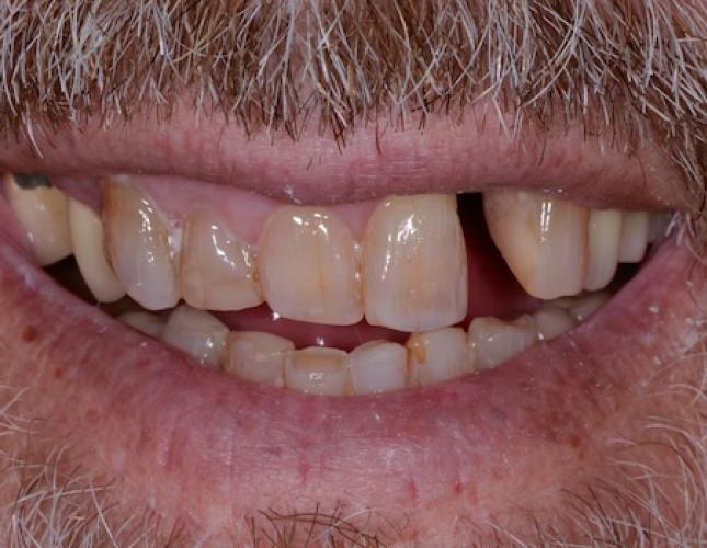 Case 4 before
