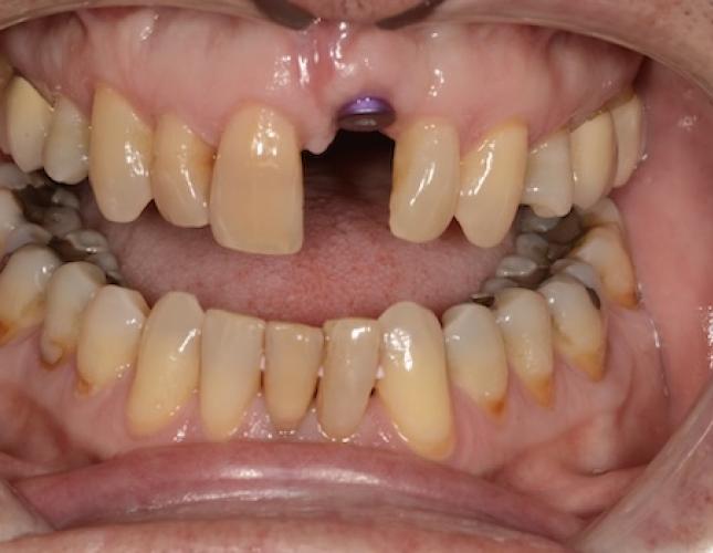 Case 5 before