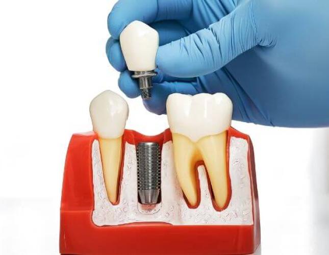 Dental Implants 101: How Your Jawbone Supports a New Tooth
